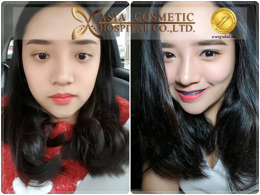 ศัลยกรรมจมูก-เสริมจมูก