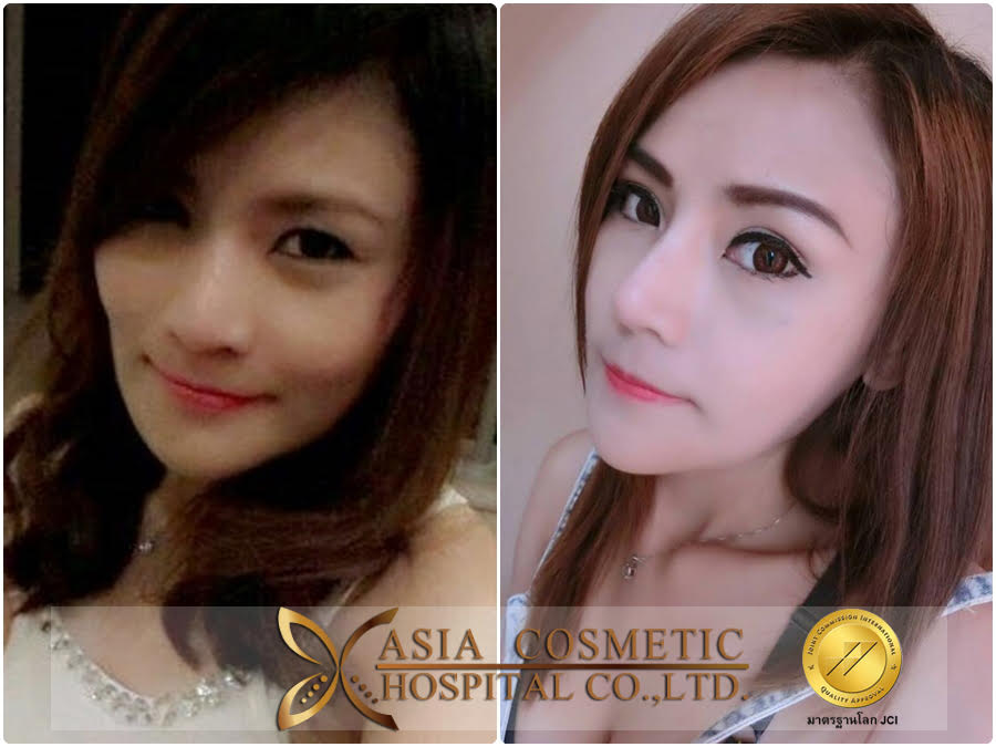 ศัลยกรรมยุบโหนกแก้ม