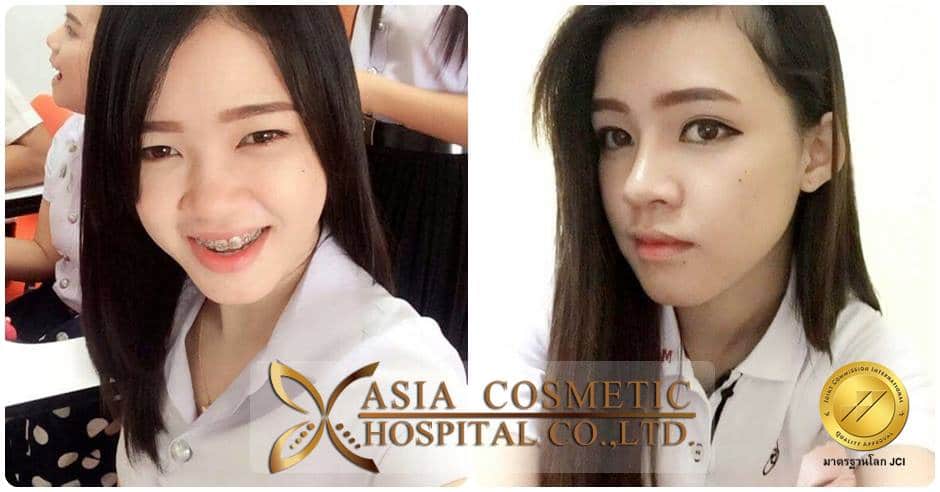 การผ่าตัดตกแต่งปลายจมูก