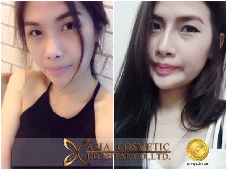 รีวิวเสริมจมูก