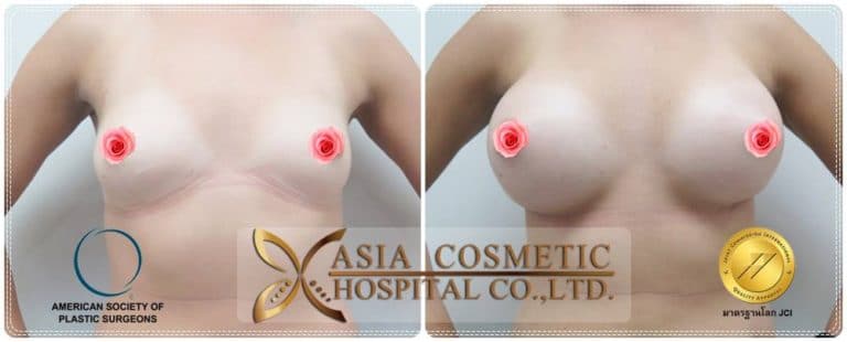 รีวิวทำหน้าอก