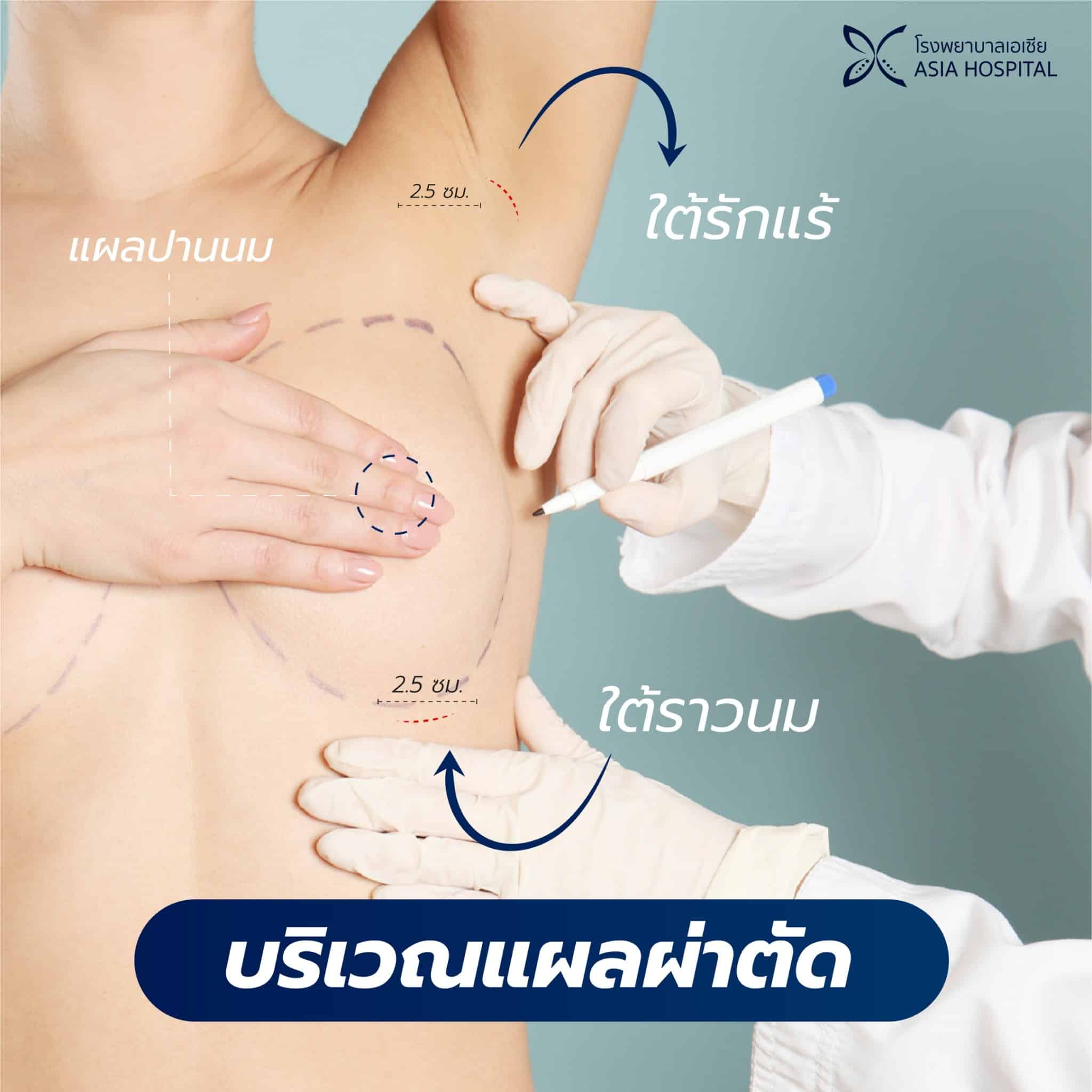 บริเวณแผลผ่าตัดเสริมหน้าอก